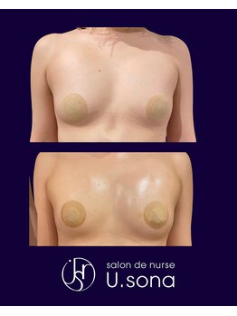 小顔・脂肪コントロール専門 salon de nurse U.sona～松本店～/【バストケア】脂肪増殖10cc