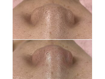 エピ(ep)/毛穴ケアbefore→after