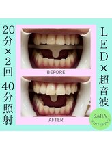 ココティ ホワイトニング(Cocotii)/ビフォーアフター