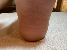 ビサンテ サロン/中々良くならない足裏スベスベに