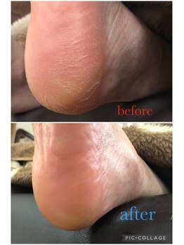 足楽ほんぽ/角質ケア