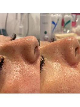 トータルエステサロン エステアンドメイク 錦糸町/ハイドロスプラッシュピーリング