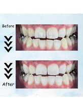 エクシアホワイトニング 塩釜口駅前店/３０代前半の男性の効果事例