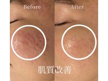 アモール(AMOR)/サーマトリックス[肌質改善3]