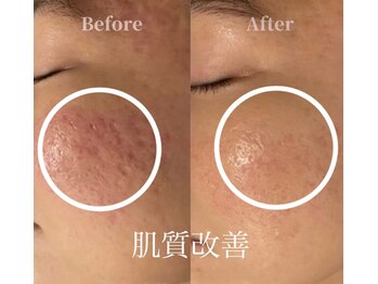 アモール(AMOR)/サーマトリックス[肌質改善3]