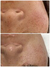 ギャラクシービューティー(galaxy beauty)/プラズマしみケア