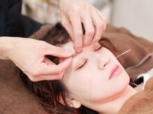 【美容鍼】小顔・むくみ・たるみケア・かみしめ対策など◎