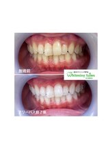 ホワイトニングサロン 名古屋駅店/【ホワイトニング施術例】