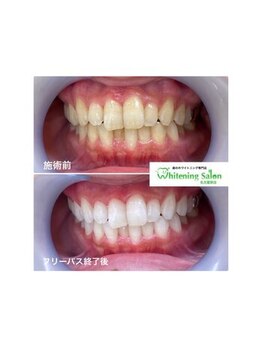 ホワイトニングサロン 名古屋駅店/【ホワイトニング施術例】
