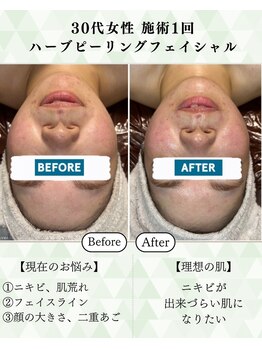 シーフェイス 横浜店(SEE FACE)/ニキビ肌荒れ肌質改善ハーブケア