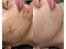 プレナ(PLENA)/ニキビケア