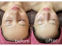 ナルシス(Narcissus)/エクソソームハーブピーリング