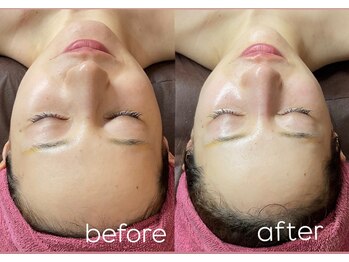 ナルシス(Narcissus)/エクソソームハーブピーリング