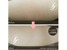 グリシーヌ(GLYCINE)/脱毛効果★