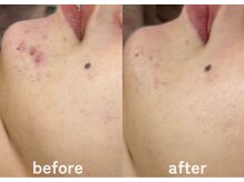 ホワイトアクア 鹿児島店(WHITE AQUA)/ハーブピーリング/ニキビケア