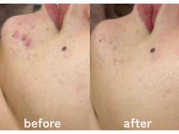 ホワイトアクア 鹿児島店(WHITE AQUA)/ハーブピーリング/ニキビケア