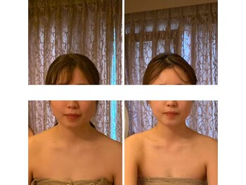 プララン 京都桂店(Plaran)/【小顔矯正】ビフォーアフター