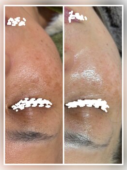 ココスタイルビューティー(COCOSTYLE beauty)/ララピールコース