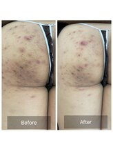 リラ(Lilas)/お尻の黒ずみもお任せ！