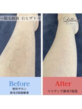 リリアン 米子店(Lillian)/ヒザ下　before after