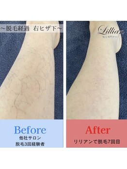 リリアン 米子店(Lillian)/ヒザ下　before after