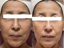 ピュアノア 三木店/肌質改善フェイシャル　三木小野