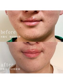 ミレ(mirae)の写真/【毎朝の大変な髭剃りから卒業へ】サロン迷子の男性も大歓迎!スピーディーな施術で仕事帰りにサクッと脱毛