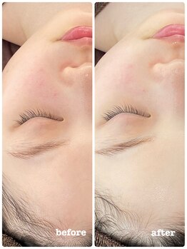 ピアーノ(PIANO)/OHL天然ハーブピーリング