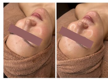 ビオトナス(Facial Esthe)/ララピール施術前後