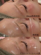 リリーミー(Rily Me)/Gloss肌トリートメント