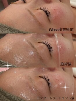 リリーミー(Rily Me)/Gloss肌トリートメント