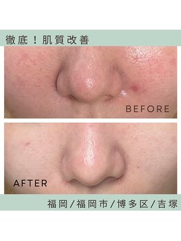 ソワ 吉塚店(soi)/赤みやテカり肌。