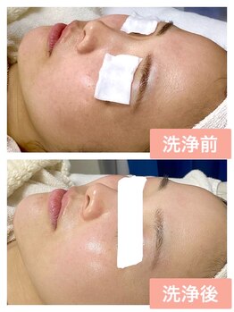 MTサロン 柏店/超音波イオン洗浄の肌変化