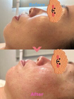 はだなの/ビフォーアフター　シリカ微細針