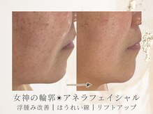 アネラボーテ(Anela Beaute)/アネラフェイシャル♪ほうれい線