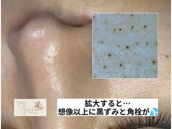 クリアホワイト(Clear White)/スコープで見た汚れ