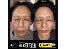 メンズ脱毛 リボーン(reborn)/サーマル【痩身】