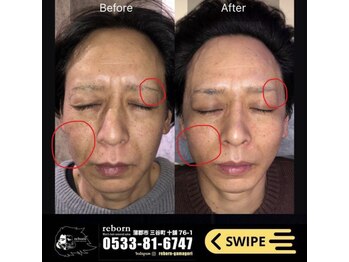 メンズ脱毛 リボーン(reborn)/サーマル【痩身】