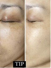 エムエルフ(emuerufu)/くすみなし透明感ＵＰ！