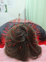 よつば鍼灸整骨院 春日院/頭皮鍼