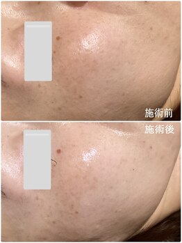 ブライトリー(Brightly)/最新光エステ1回で透明感アップ