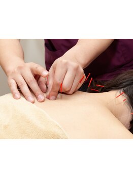 鍼灸施術を受けたい