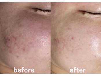 ホワイトアクア 鹿児島店(WHITE AQUA)/ハーブピーリング/肌質改善/荒田