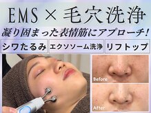 ベル アージュ/EMS×毛穴洗浄