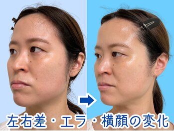 ナチュラルビューティーフェイス 横浜(NBF)/エラ張り・横顔の変化/横浜小顔