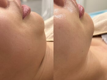 ビューティービレッジ(Beauty village)/フェイスラインのたるみ改善