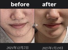 リベルテ(LIBERTE)/before after