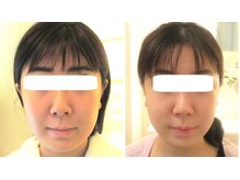 サロンドエステケイワイ(de KY)/フェイシャル☆小顔・タルミ改善