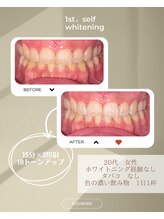 スリール(sourire)/ビフォーアフター