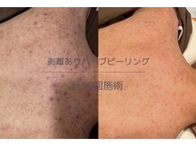 ライフサロン 天神(Life Salon)/メンズ背中のハーブピーリング